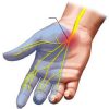 Carpal-Tunnel-Syndrome-distribution3