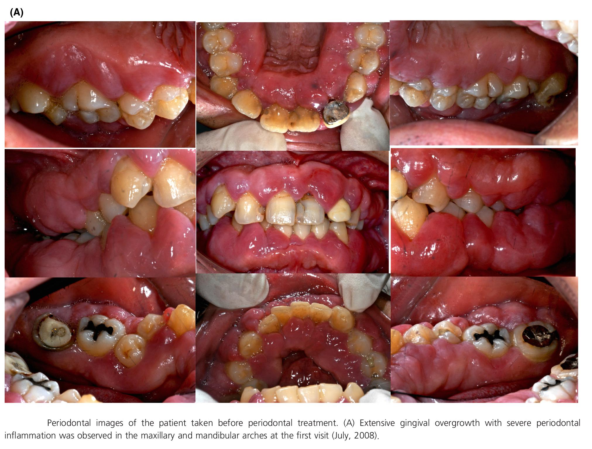 Scurvy Vitamin C deficiency